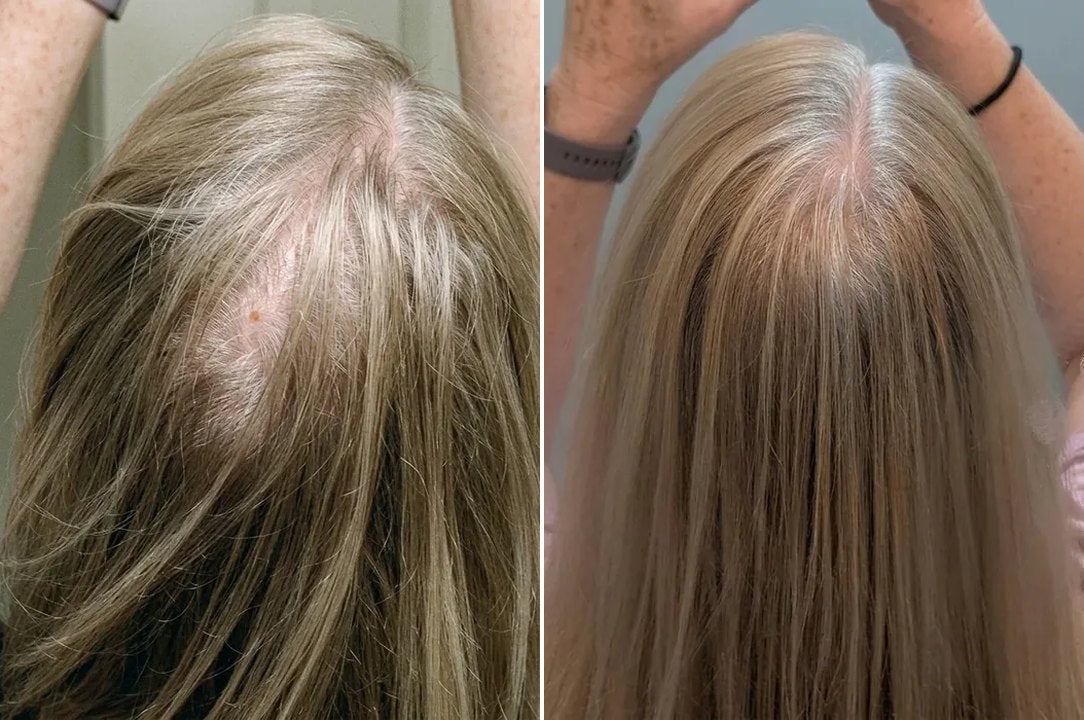 Fiona W.'s crown before and after 12 weeks