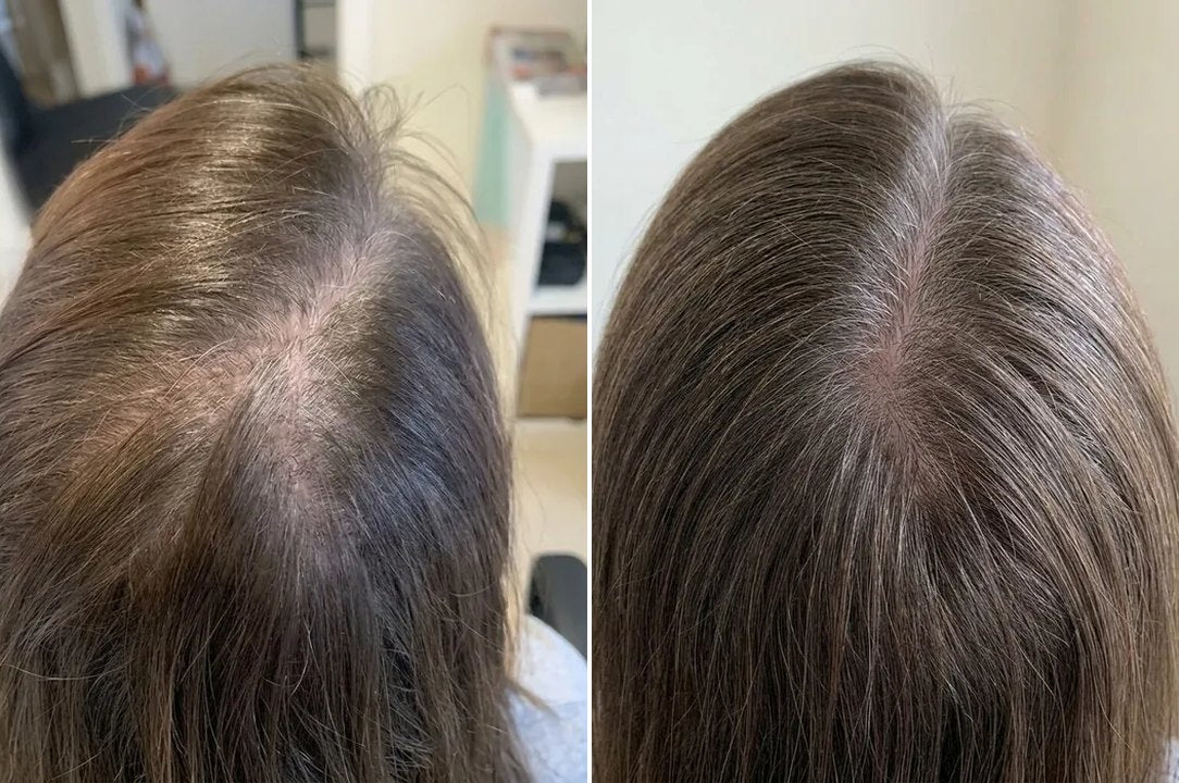 Laura B.'s crown before, and 20 weeks later